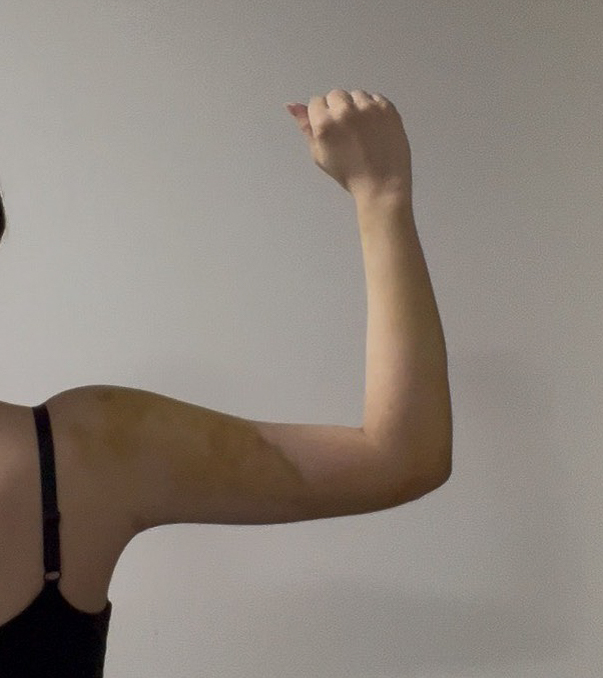 二の腕の脂肪吸引