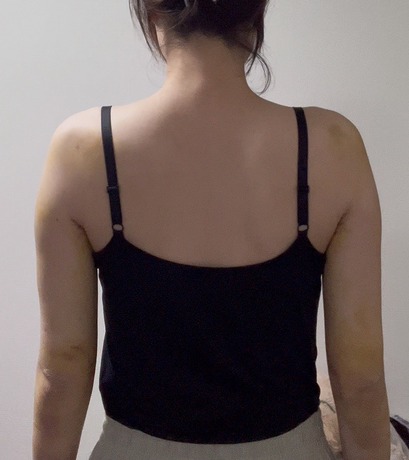 二の腕の脂肪吸引