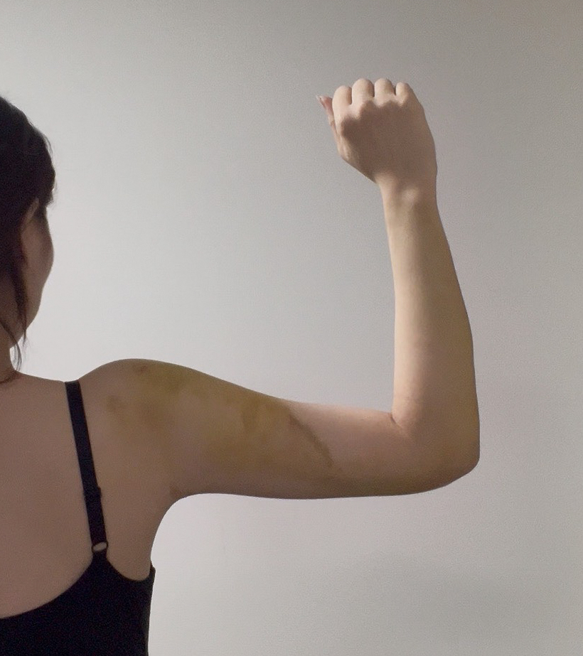 二の腕の脂肪吸引