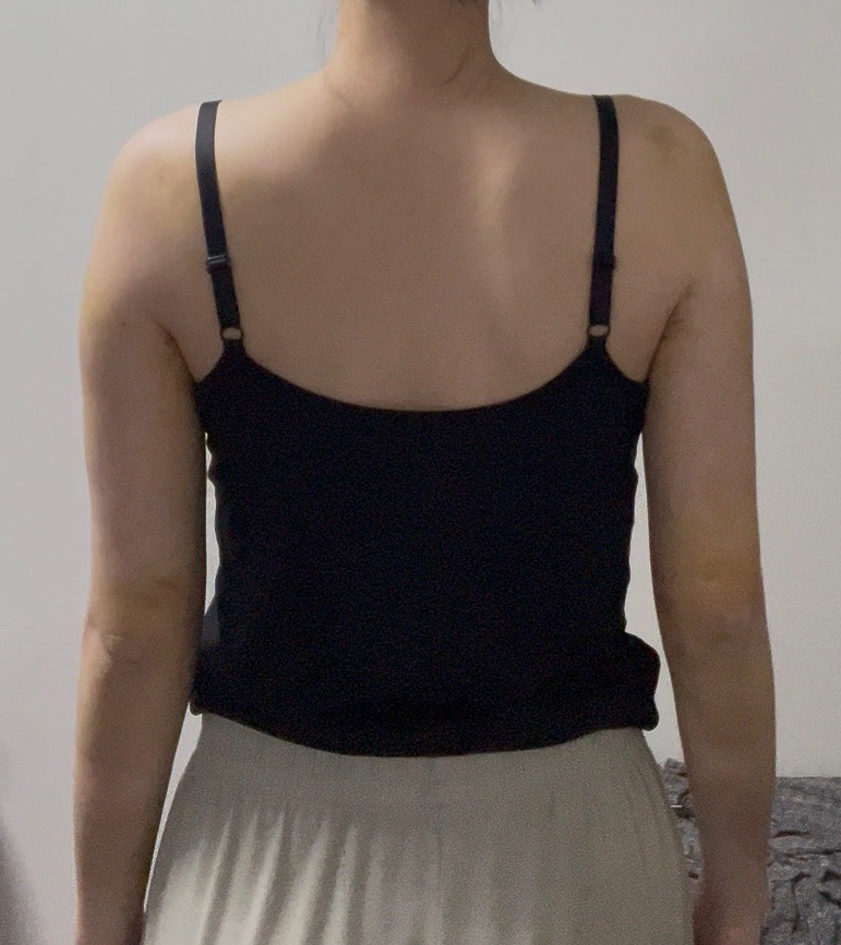 二の腕の脂肪吸引