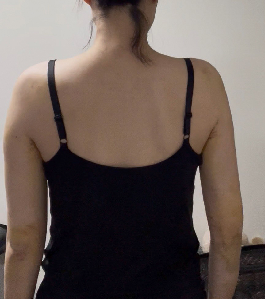 二の腕の脂肪吸引