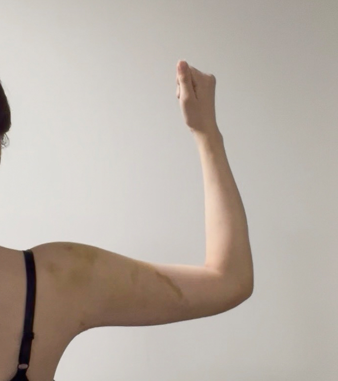 二の腕の脂肪吸引