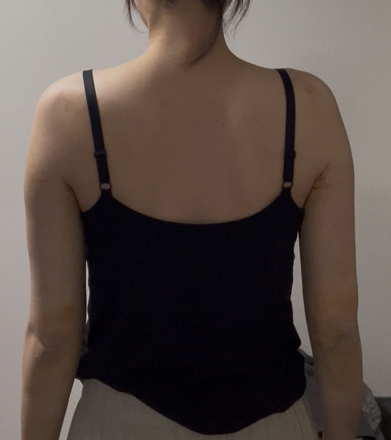 二の腕の脂肪吸引