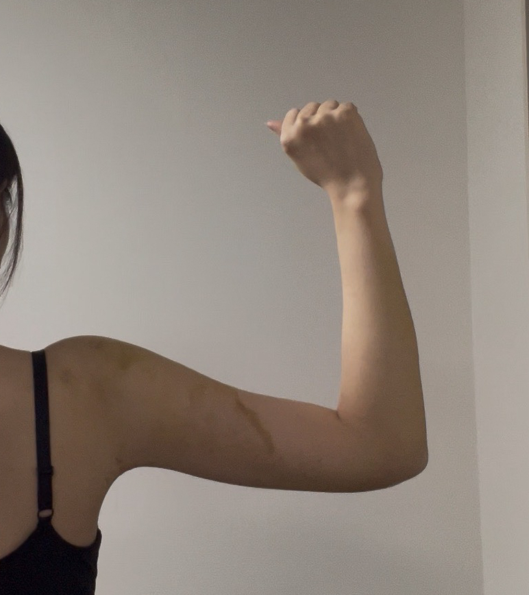 二の腕の脂肪吸引