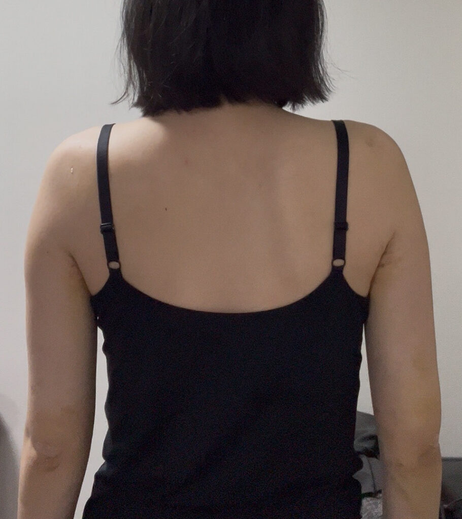 二の腕の脂肪吸引