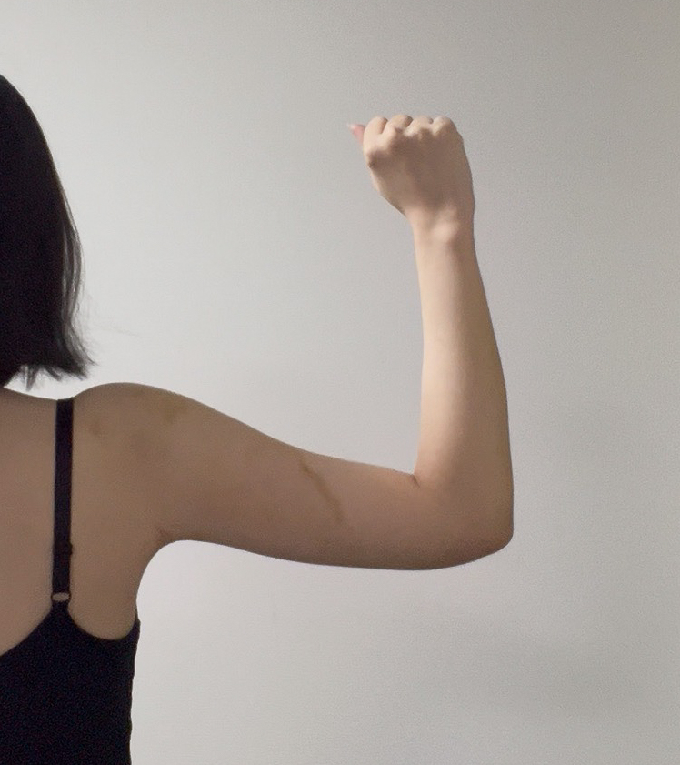 二の腕の脂肪吸引