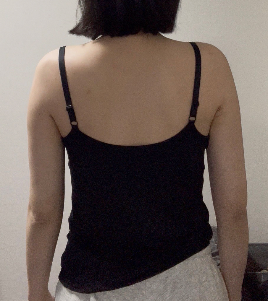 二の腕の脂肪吸引