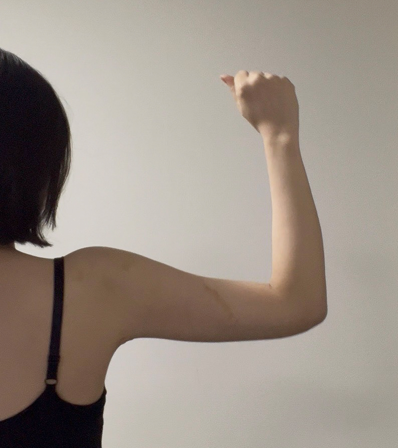 二の腕の脂肪吸引