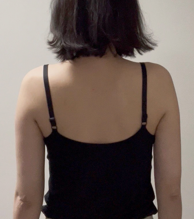 二の腕の脂肪吸引