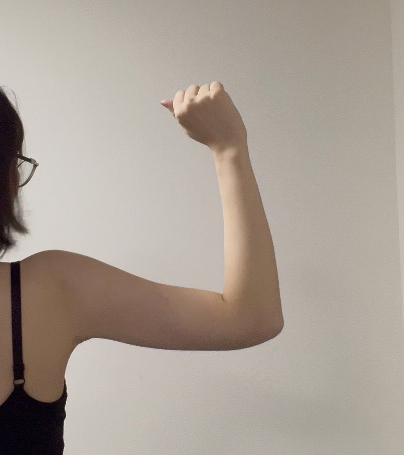 二の腕の脂肪吸引