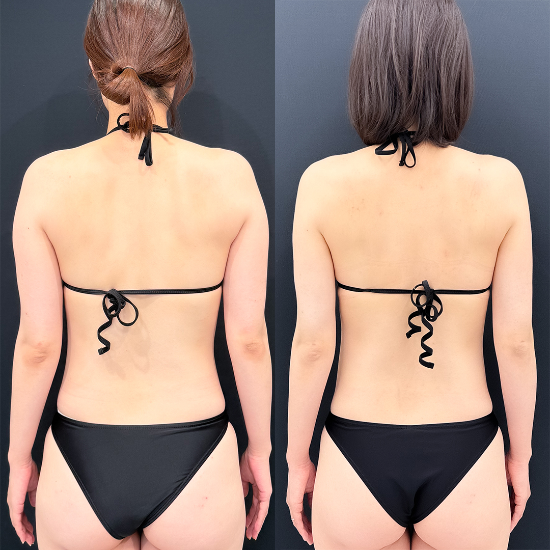 二の腕の脂肪吸引