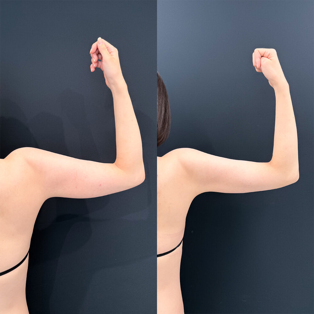 二の腕の脂肪吸引