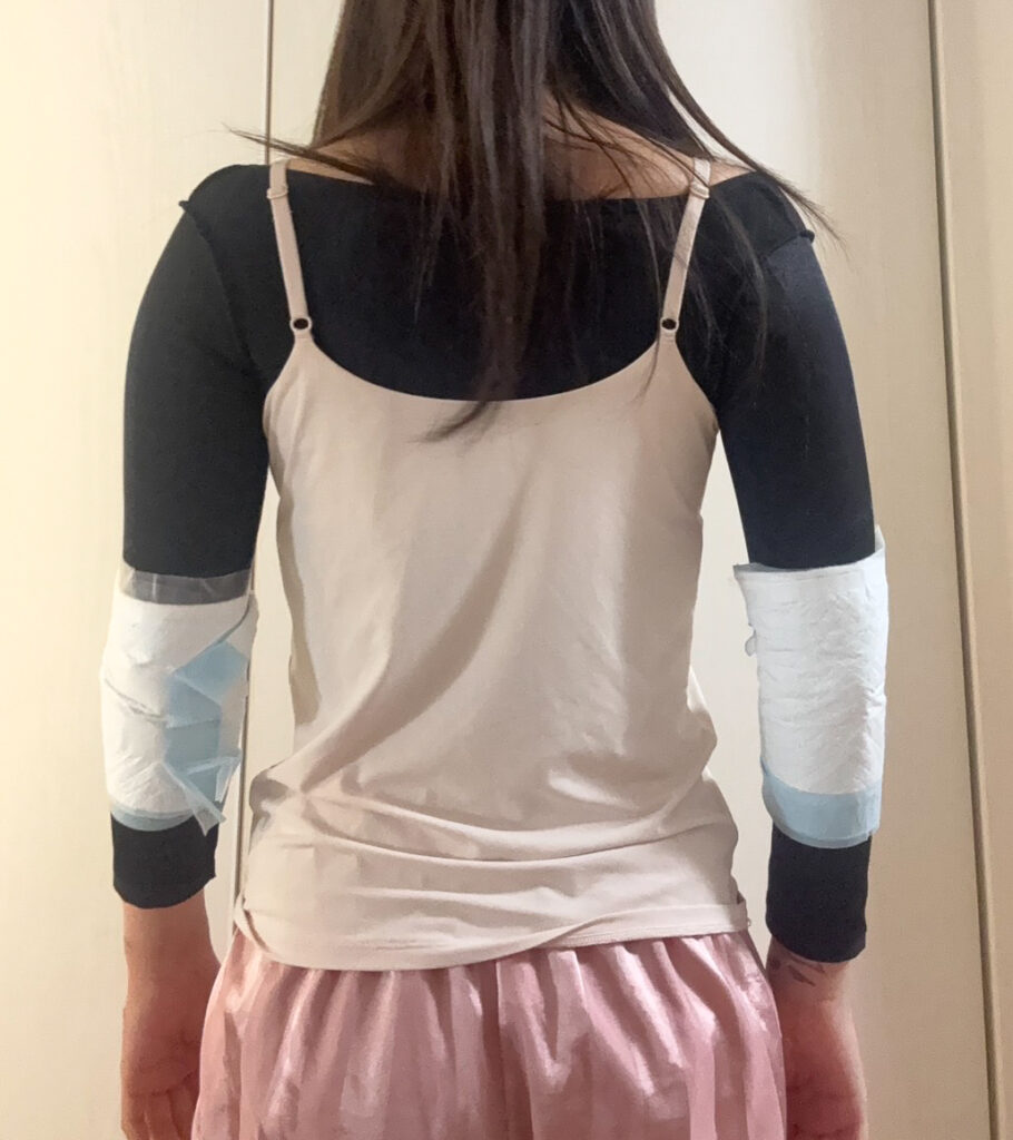 二の腕の脂肪吸引