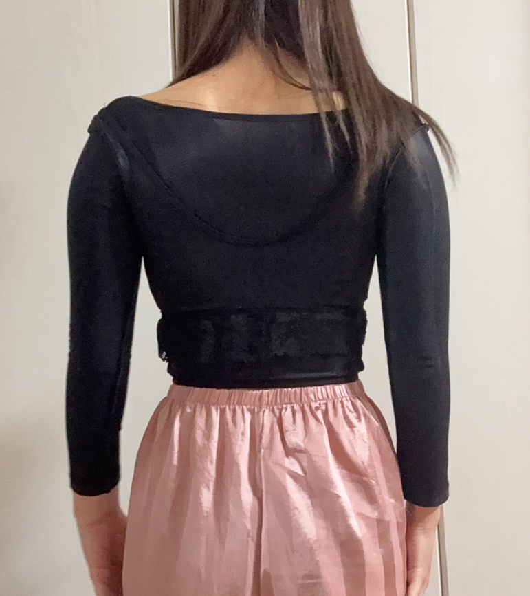 二の腕の脂肪吸引