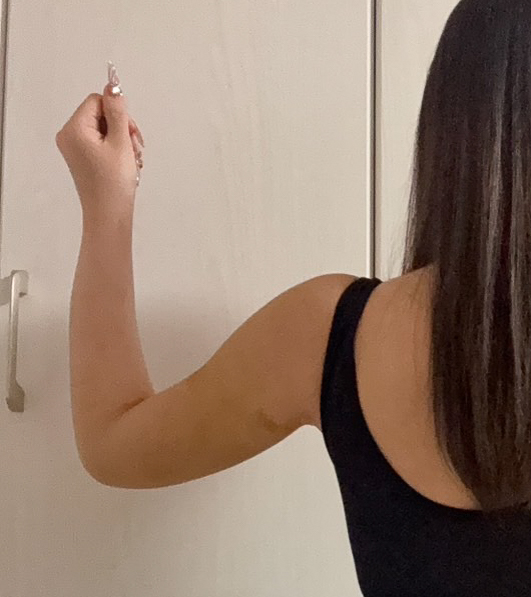 二の腕の脂肪吸引