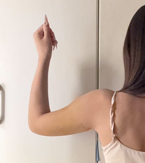 二の腕の脂肪吸引