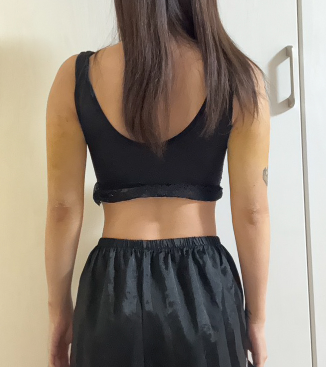 二の腕の脂肪吸引