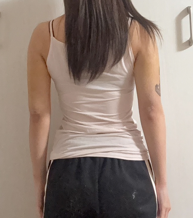 二の腕の脂肪吸引