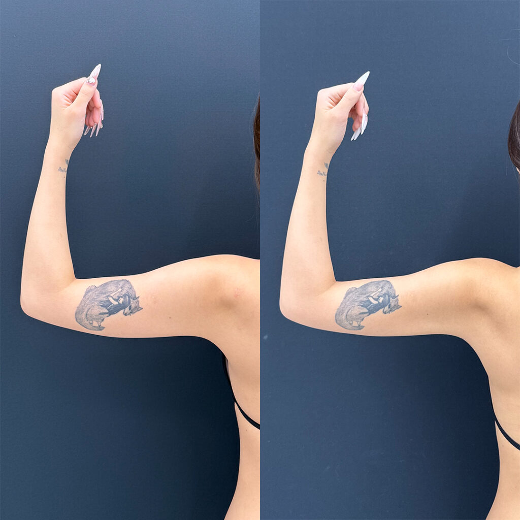 二の腕の脂肪吸引