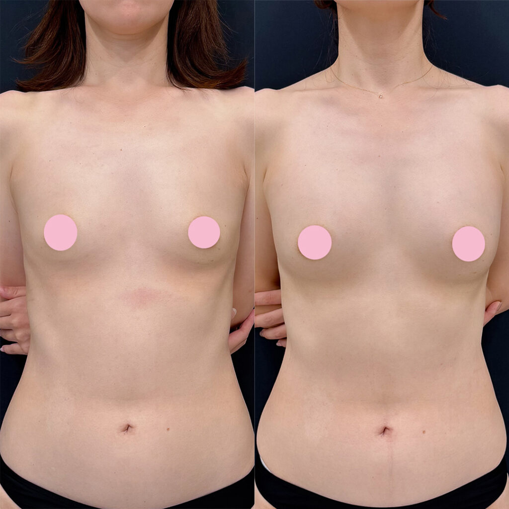 脂肪豊胸