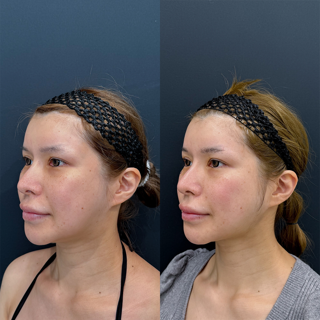 https://purelys-tokyo-clinic.com/wp/wp-content/uploads/2025/12/face-Liposuction_Case-No.205.jpg