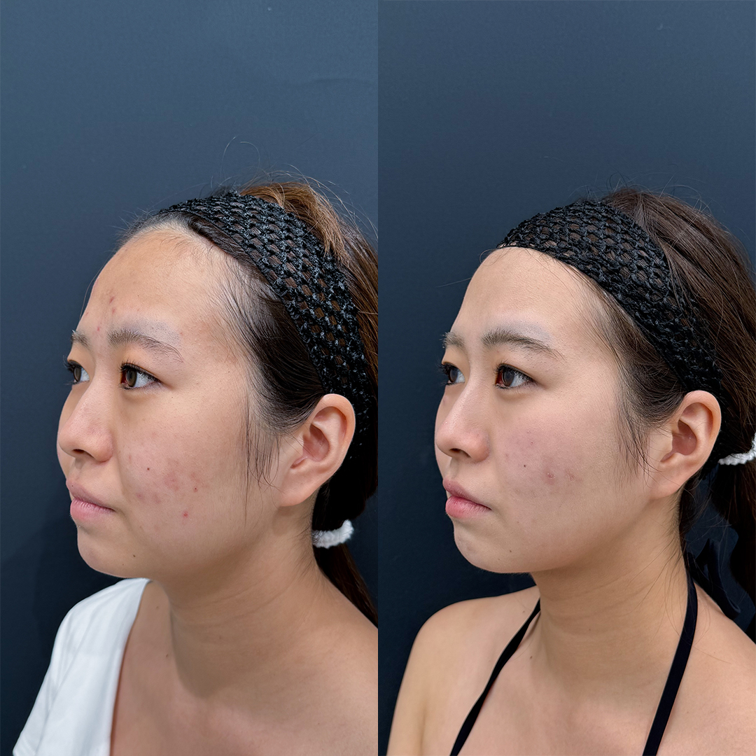https://purelys-tokyo-clinic.com/wp/wp-content/uploads/2025/12/face-Liposuction_Case-No.263.jpg