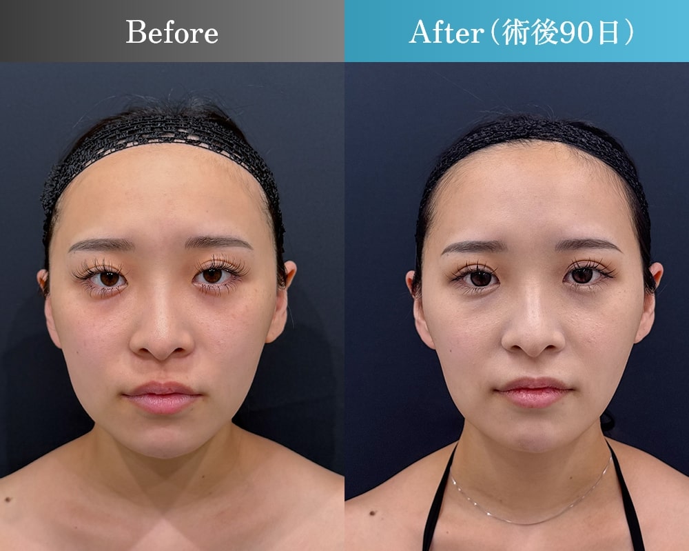 三浦 航医師の脂肪吸引症例-正面