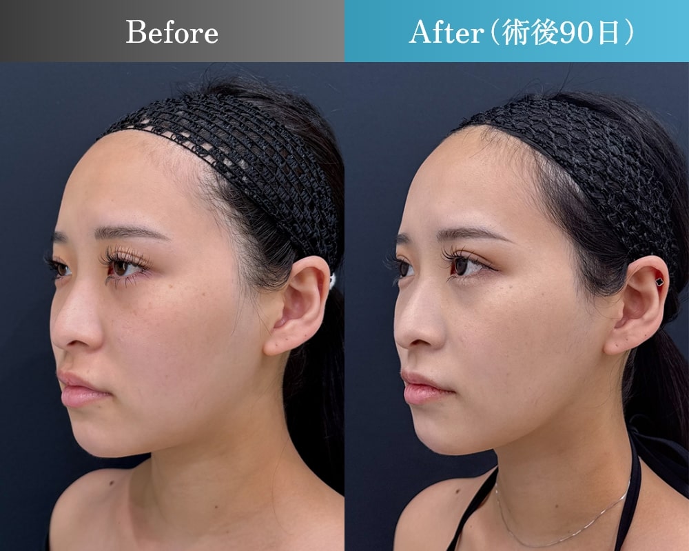 三浦 航医師の脂肪吸引症例-サイド