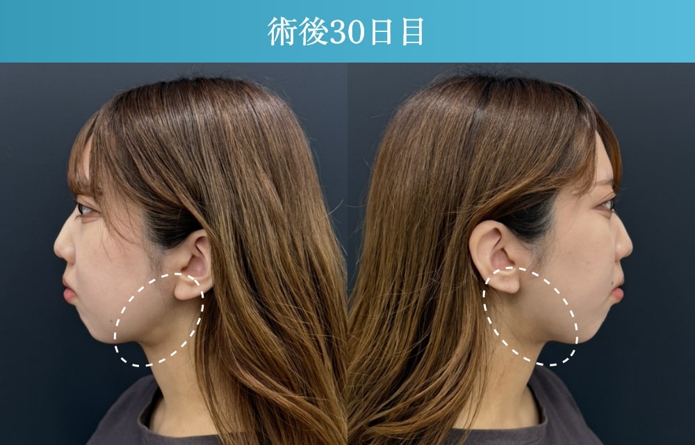 顔の脂肪吸引の拘縮症例(施術後30日目)