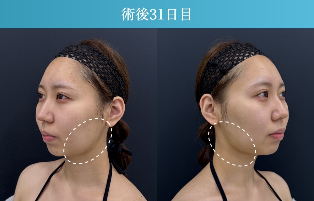 顔の脂肪吸引の拘縮症例(施術後31日目)