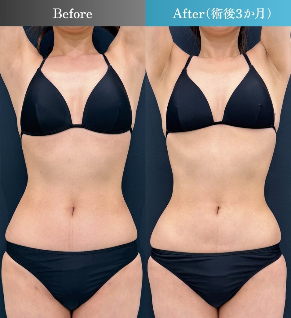 上腹・下腹・側腹部・ウエストの脂肪吸引（術後3ヶ月）