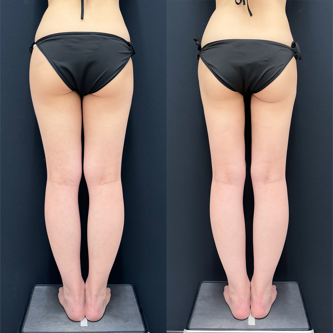 https://purelys-tokyo-clinic.com/wp/wp-content/uploads/2025/12/leg-Liposuction_Case-No.113.jpg