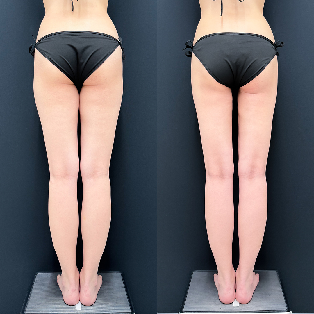 https://purelys-tokyo-clinic.com/wp/wp-content/uploads/2025/12/leg-Liposuction_Case-No.114.jpg
