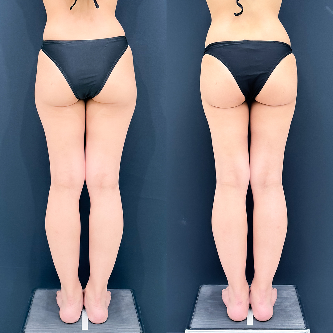 https://purelys-tokyo-clinic.com/wp/wp-content/uploads/2025/12/leg-Liposuction_Case-No.116.jpg