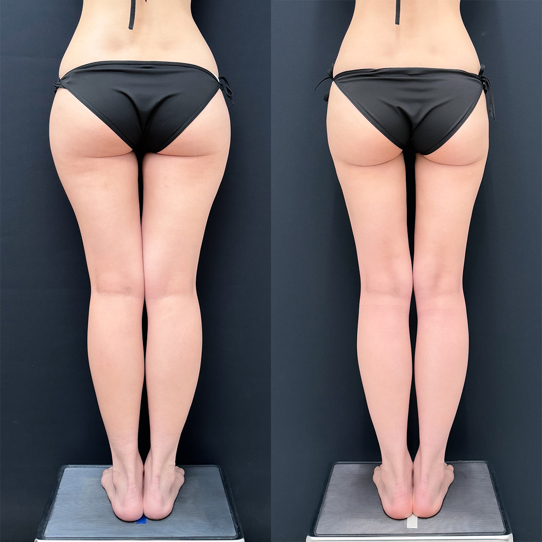 https://purelys-tokyo-clinic.com/wp/wp-content/uploads/2025/12/leg-Liposuction_Case-No.150.jpg