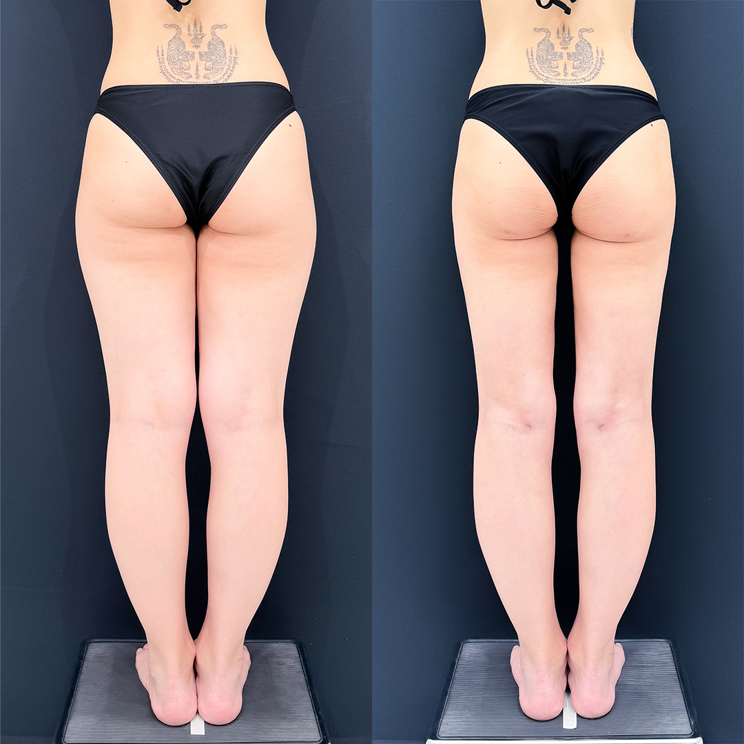 https://purelys-tokyo-clinic.com/wp/wp-content/uploads/2025/12/leg-Liposuction_Case-No.151-1.jpg