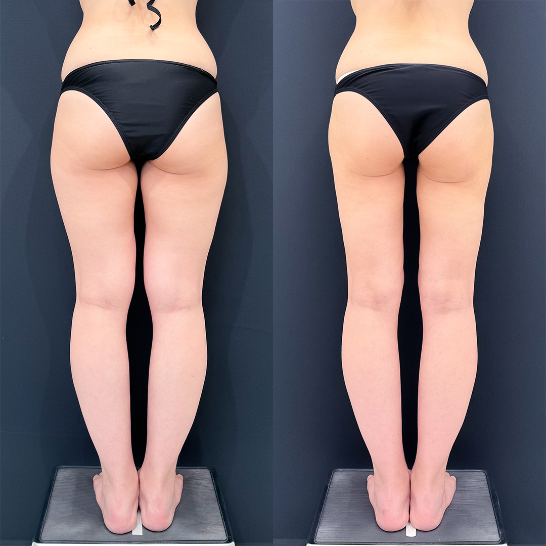 https://purelys-tokyo-clinic.com/wp/wp-content/uploads/2025/12/leg-Liposuction_Case-No.203.jpg