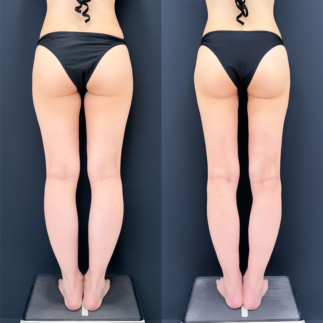 https://purelys-tokyo-clinic.com/wp/wp-content/uploads/2025/12/leg-Liposuction_Case-No.207.jpg