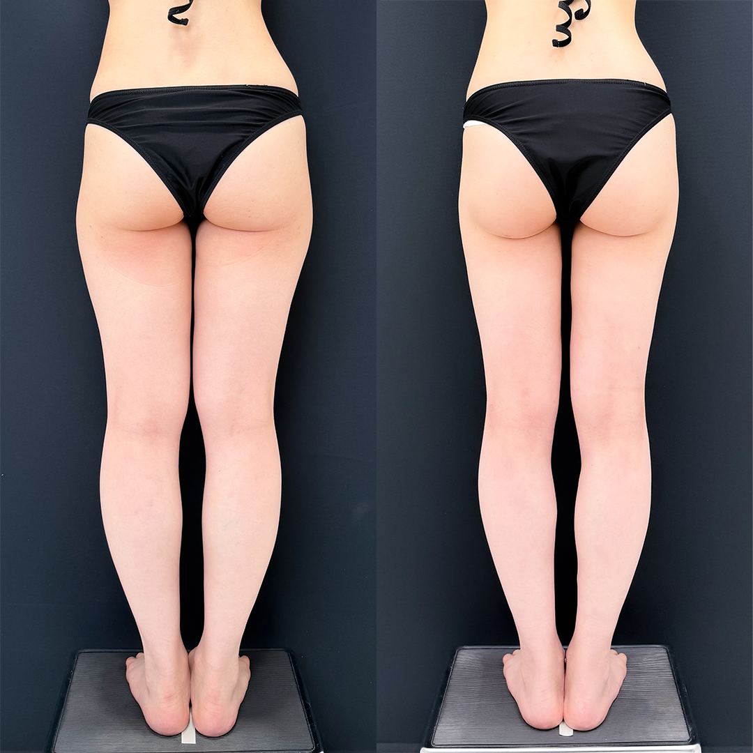 https://purelys-tokyo-clinic.com/wp/wp-content/uploads/2025/12/leg-Liposuction_Case-No.267.jpg