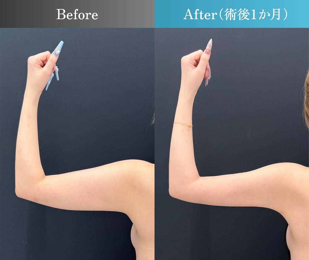 二の腕 脂肪吸引の症例写真