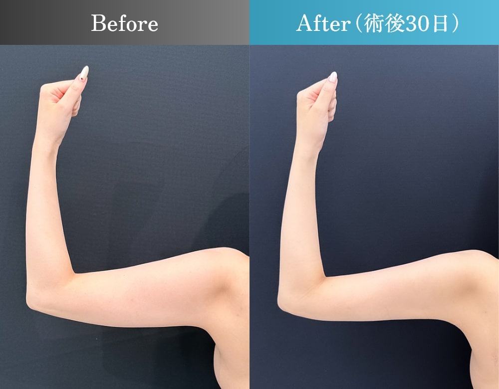 二の腕全周・肩・肩甲骨上下の脂肪吸引（術後30日）