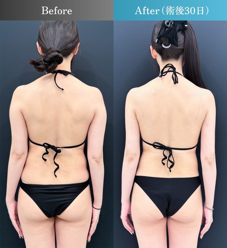 二の腕全周・肩・肩甲骨上下の脂肪吸引（術後30日）