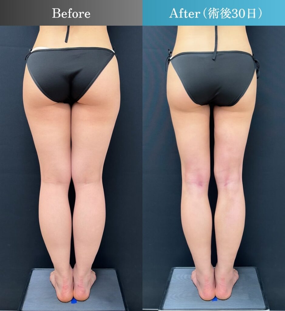 太もも全周＋膝＋臀部の脂肪吸引（術後30日）