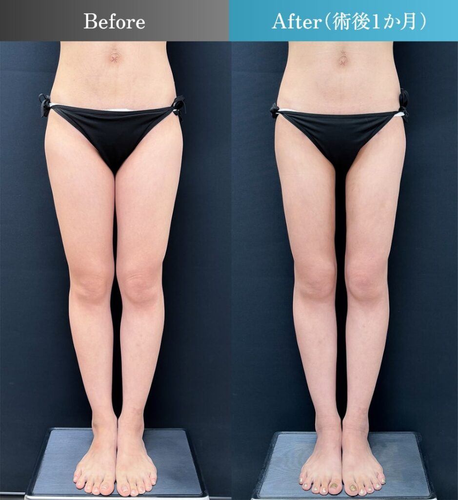 太もも・お尻 脂肪吸引の症例写真