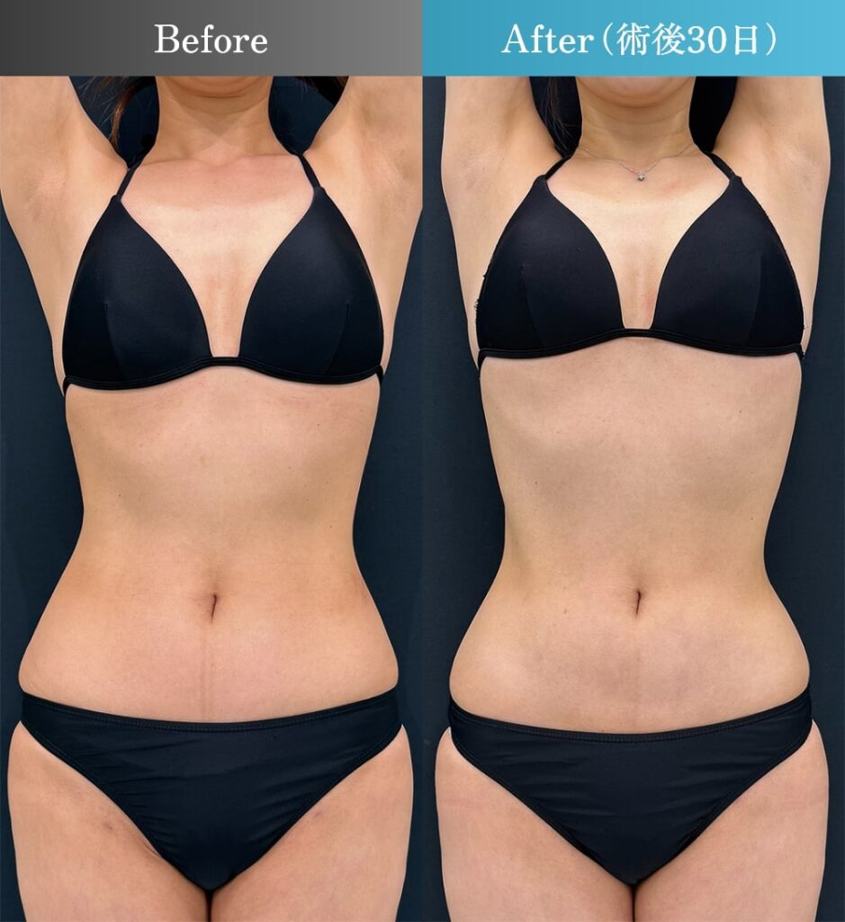 お腹・ウエスト・腰 脂肪吸引の症例写真
