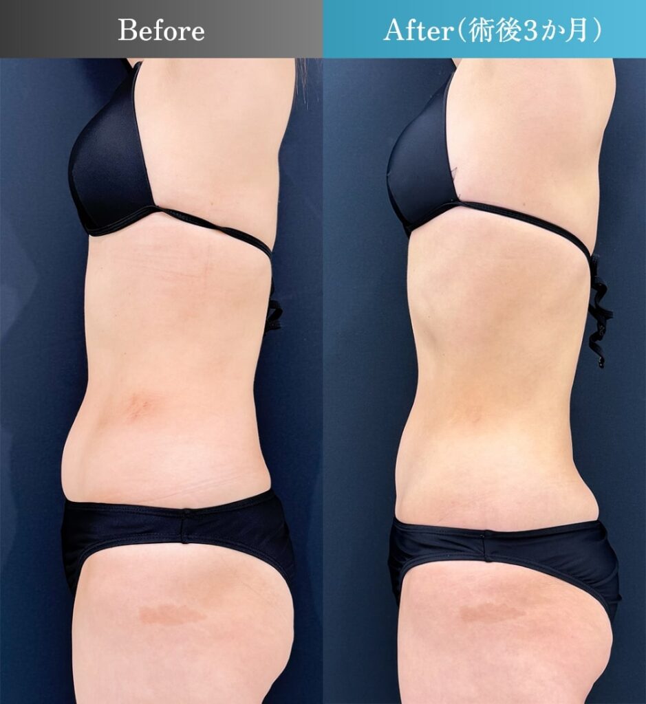 上腹・下腹・側腹部・ウエストの脂肪吸引（術後3ヶ月）