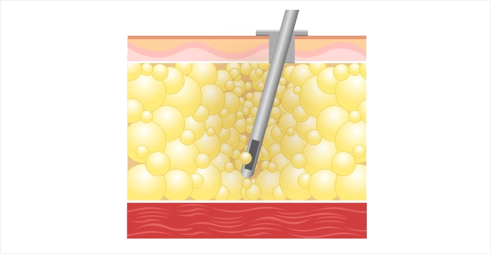 脂肪吸引の様子