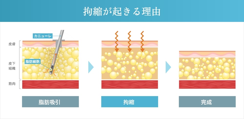 拘縮が起きる理由