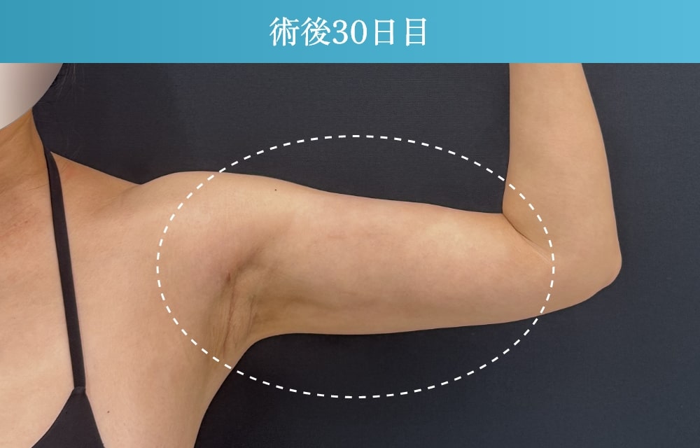 二の腕の脂肪吸引の拘縮症例(施術後31日目)