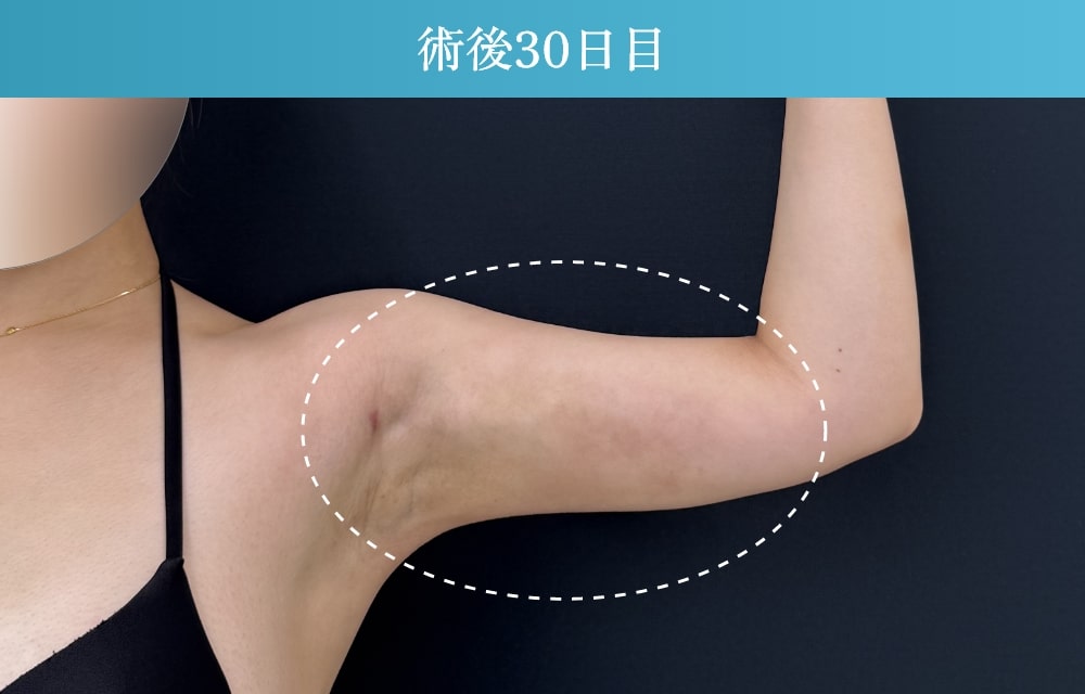 二の腕の脂肪吸引の拘縮症例(施術後30日目)